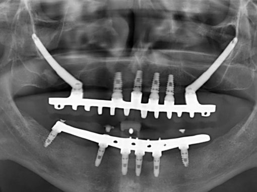 Implantes zigomaticos posteriores complementados en el sector anterior con implantes convencionales